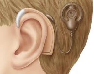 Implantes cocleares hará Capresoca a 7 pacientes en Yopal
