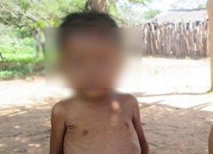 Niño de 7 años de resguardo Macucuana de Orocué murió por insuficiencia renal