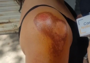 Madre e hija lesionadas en nuevo caso de raponazo en Yopal