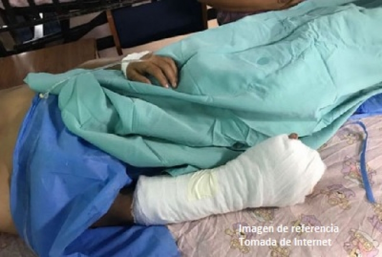 Aumentan los casos de quemados con pólvora en Casanare
